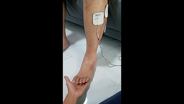 Stroke Rehab - Electrical Stimulation for Foot Drop
